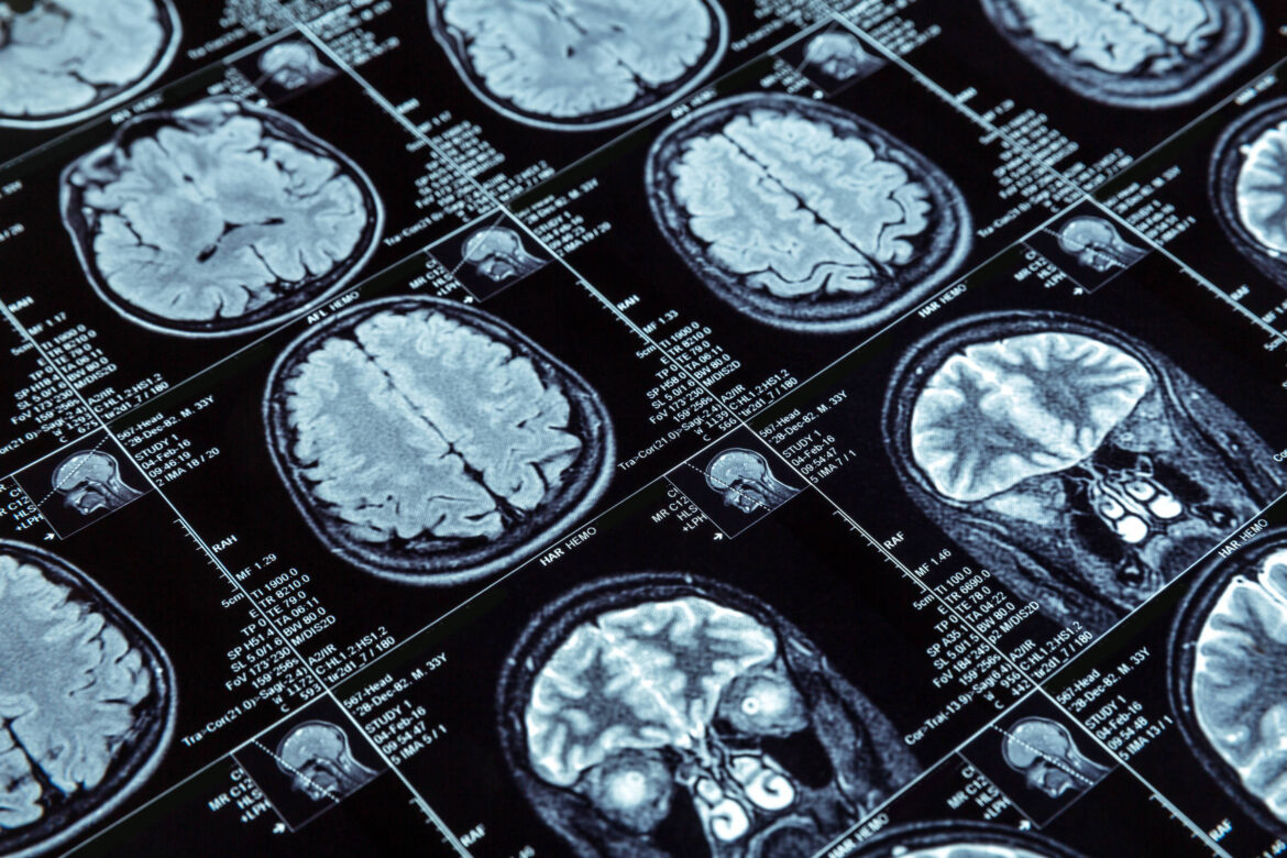 cinco-novidades-promissoras-no-combate-ao-alzheimer-descobertas-em-2025