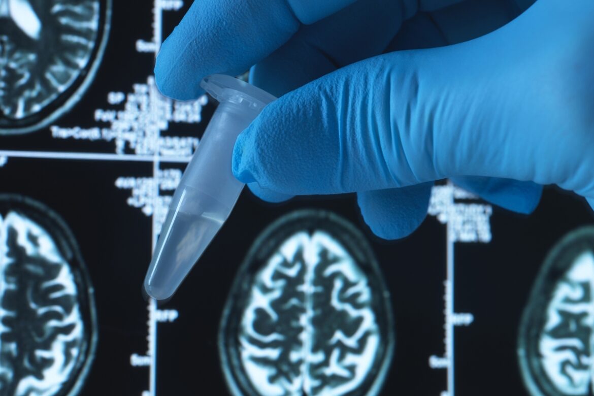 brasileiros-testam-novo-remedio-de-baixo-custo-contra-alzheimer
