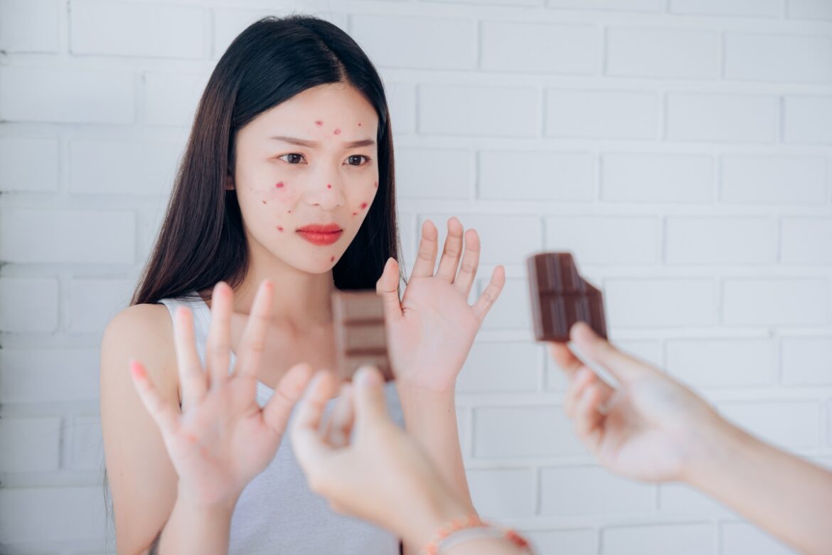chocolate-causa-espinha?-dermatologista-da-o-seu-veredito