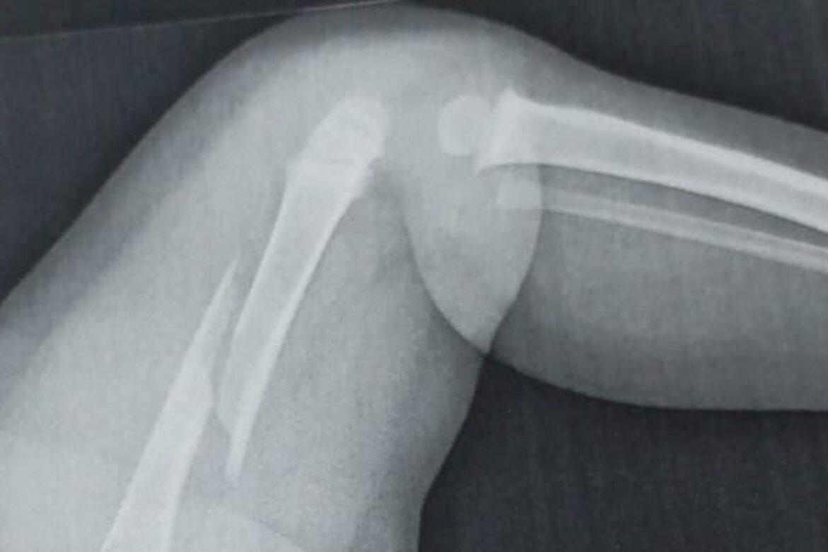 policia-investiga-fratura-de-femur-em-crianca-de-1-ano-e-5-meses-no-pr